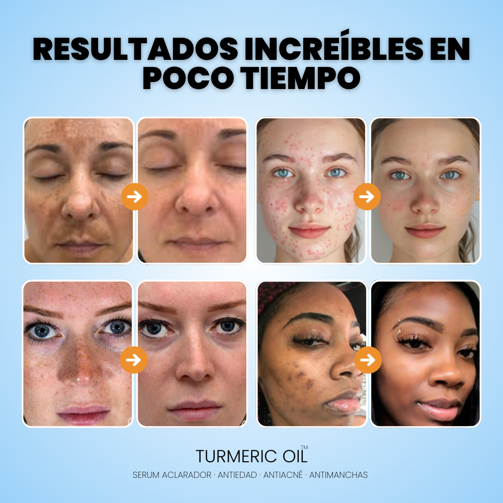 Cúrcuma y Vitamina C | Serum elimina IMPERFECCIONES - TURMERIC OIL™ (1 + 1 GRATIS)