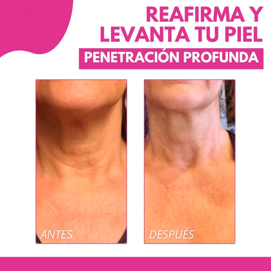 HorizonCream® La única crema con colágeno hidrolizado, respaldada por la Organización Mundial, que borra las arrugas de tu rostro y cuello en tiempo récord.