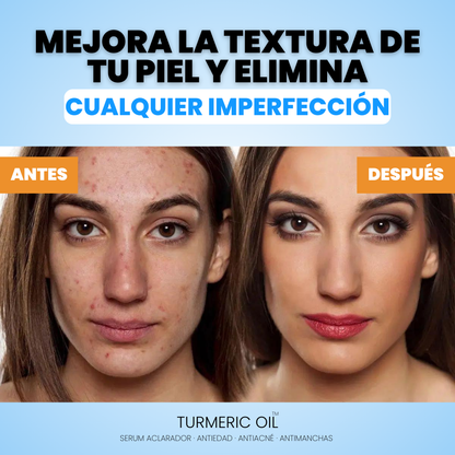 Cúrcuma y Vitamina C | Serum elimina IMPERFECCIONES - TURMERIC OIL™ (1 + 1 GRATIS)